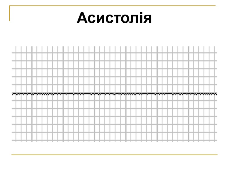 Асистолія